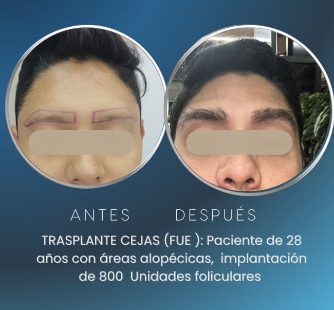Trasplante de Cejas Pilosus Medicina capilar en Bogotá